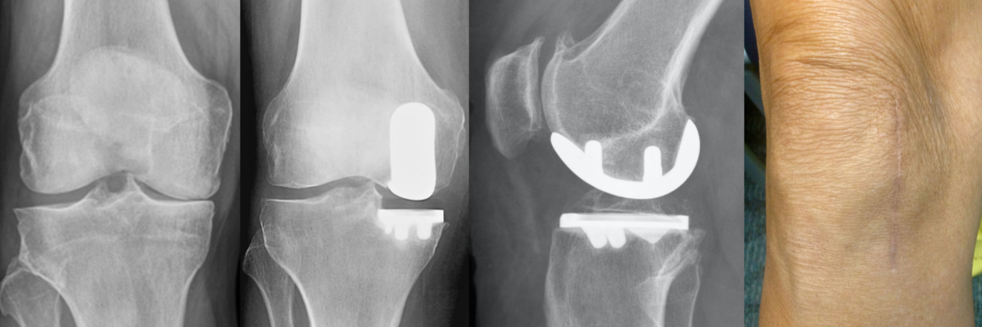 X-rays of patient's knee before and after medial partial knee replacement surgery.