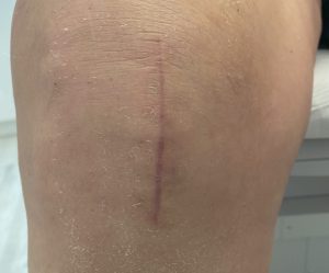 Knee of a patient after medial partial knee replacement