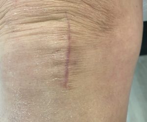 Knee of a patient after medial partial knee replacement