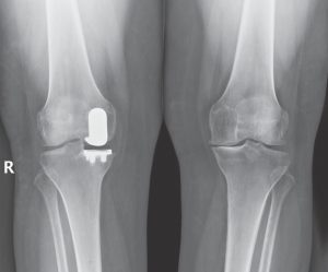 knees x-ray of a patient after medial partial knee replacement