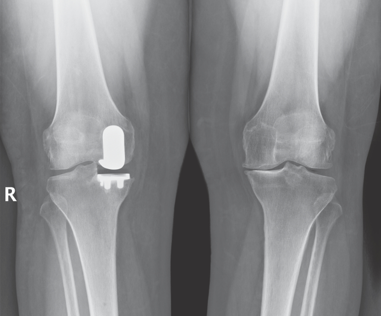 NYC Medial Partial Knee Replacement Robotic Partial Knee Replacement