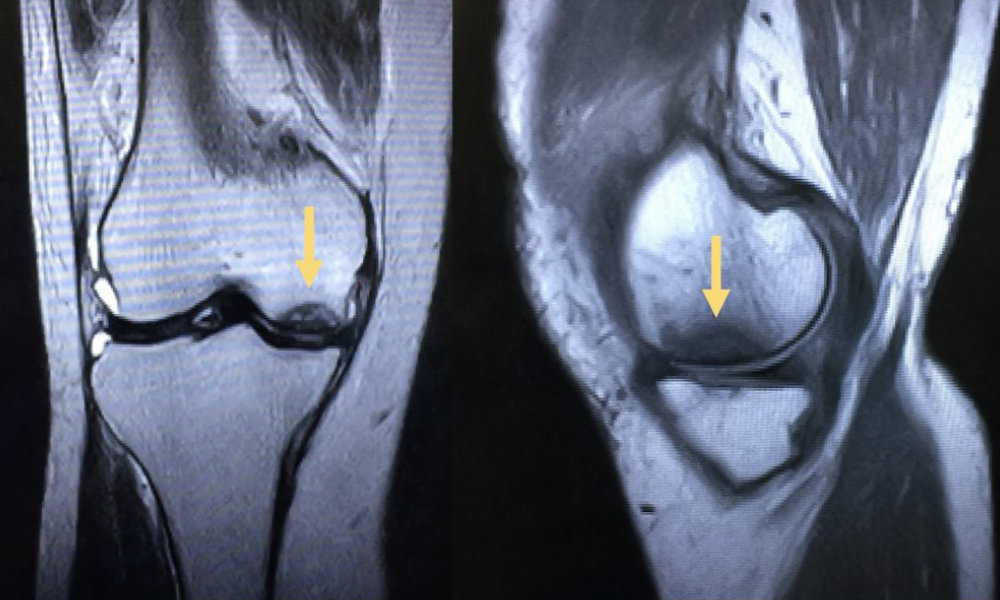 knee osteonecrosis MRI