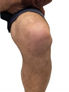 knee