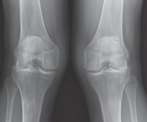 knees x-ray of a patient before lateral partial knee replacement surgery