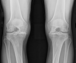 knees x-ray of a patient before lateral partial knee replacement surgery