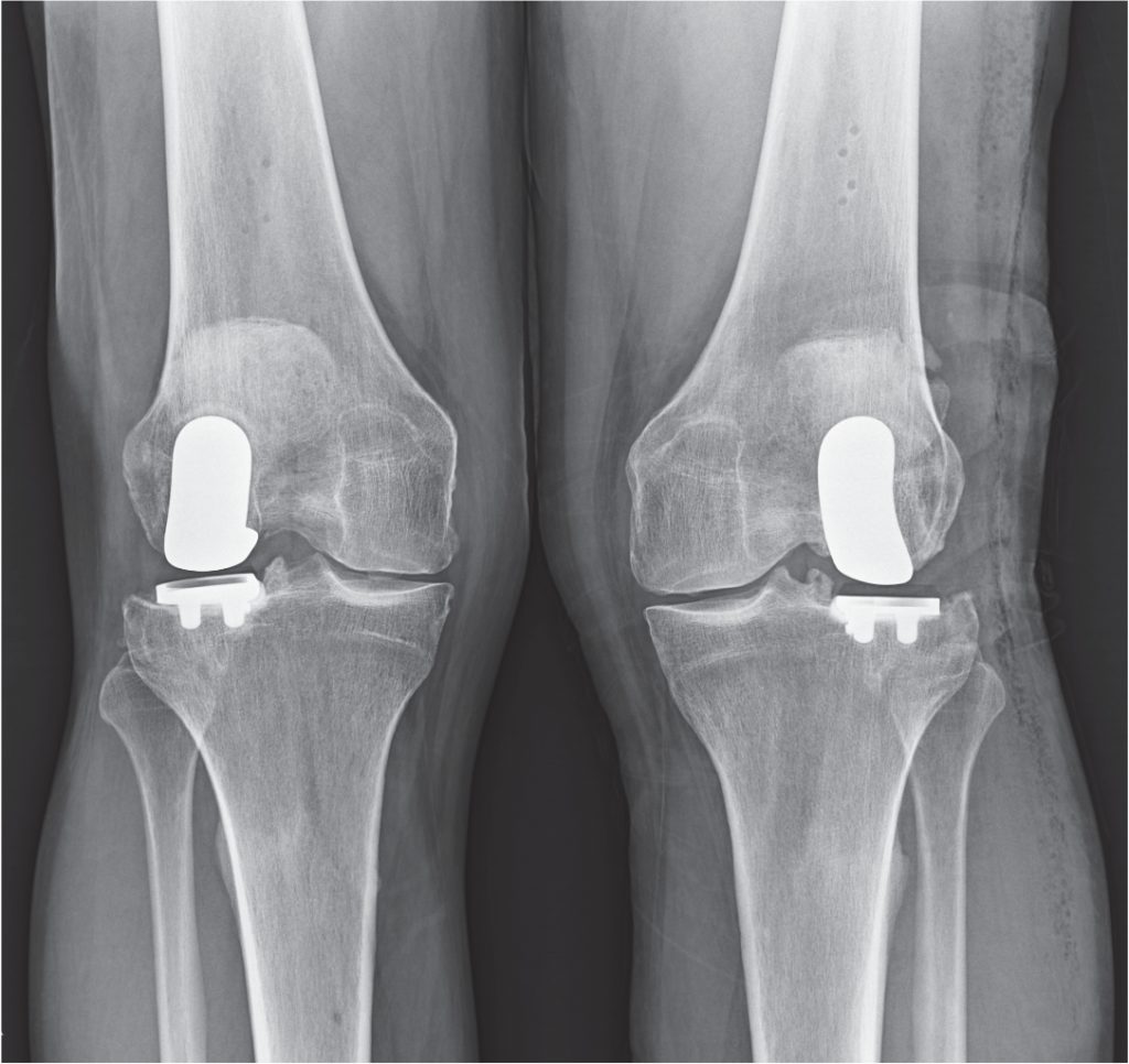 NYC Lateral Partial Knee Replacement Robotic Partial Knee Replacement