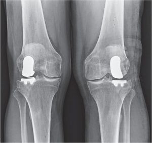 knees x-ray of a patient after lateral partial knee replacement surgery
