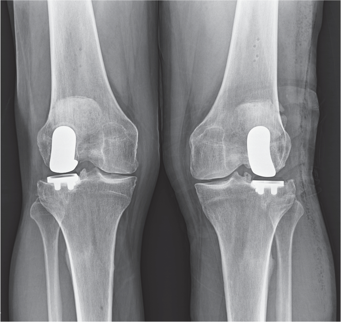 NYC Lateral Partial Knee Replacement Robotic Partial Knee Replacement