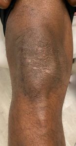 Knee of a patient after lateral partial knee replacement