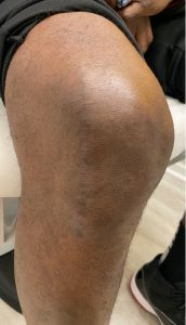 Knee of a patient after lateral partial knee replacement