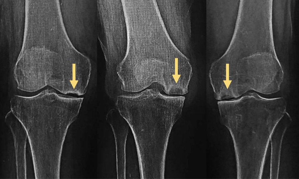 x-rays of a knee joint with osteonecrosis