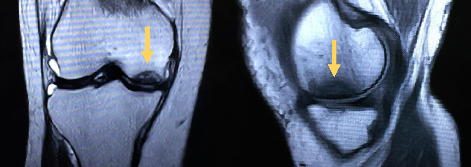 MRI of knee osteonecrosis