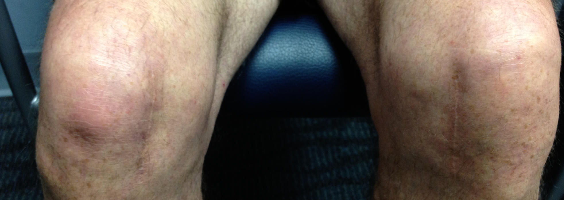 Healed knees of a patient after robotic knee surgery