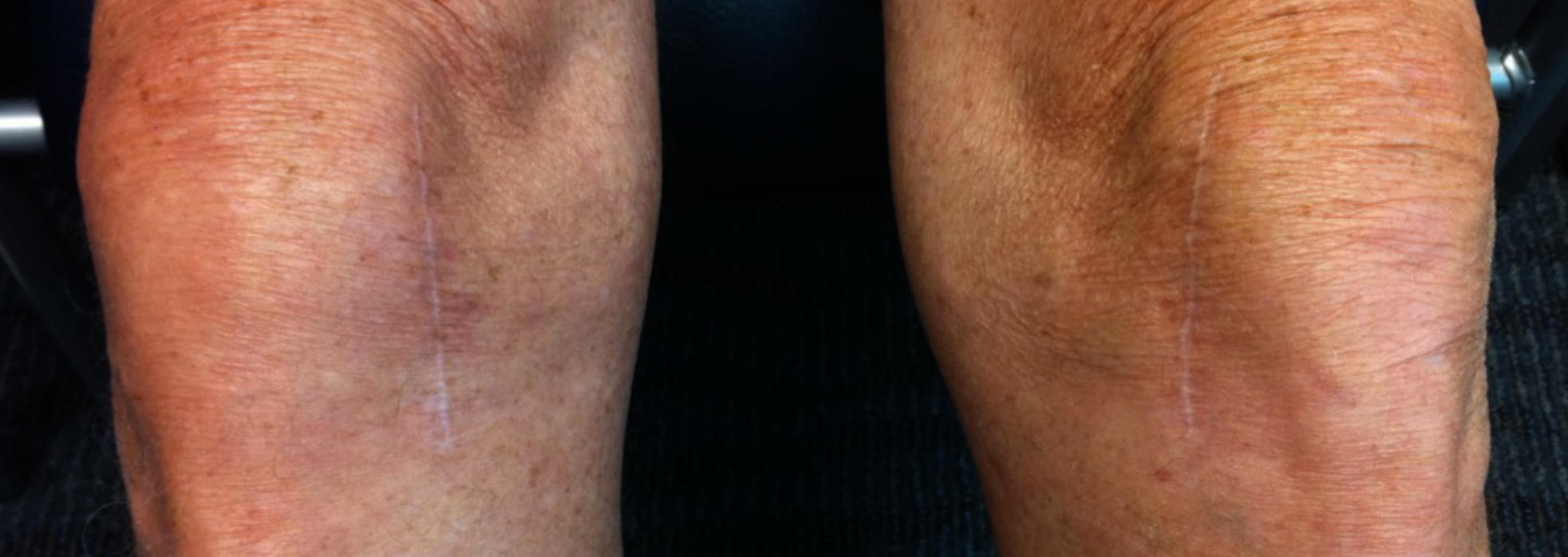 Healed knees of a patient after robotic knee surgery