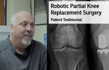 Robotic Partial Knee Replacement Surgery Patient Testimonial