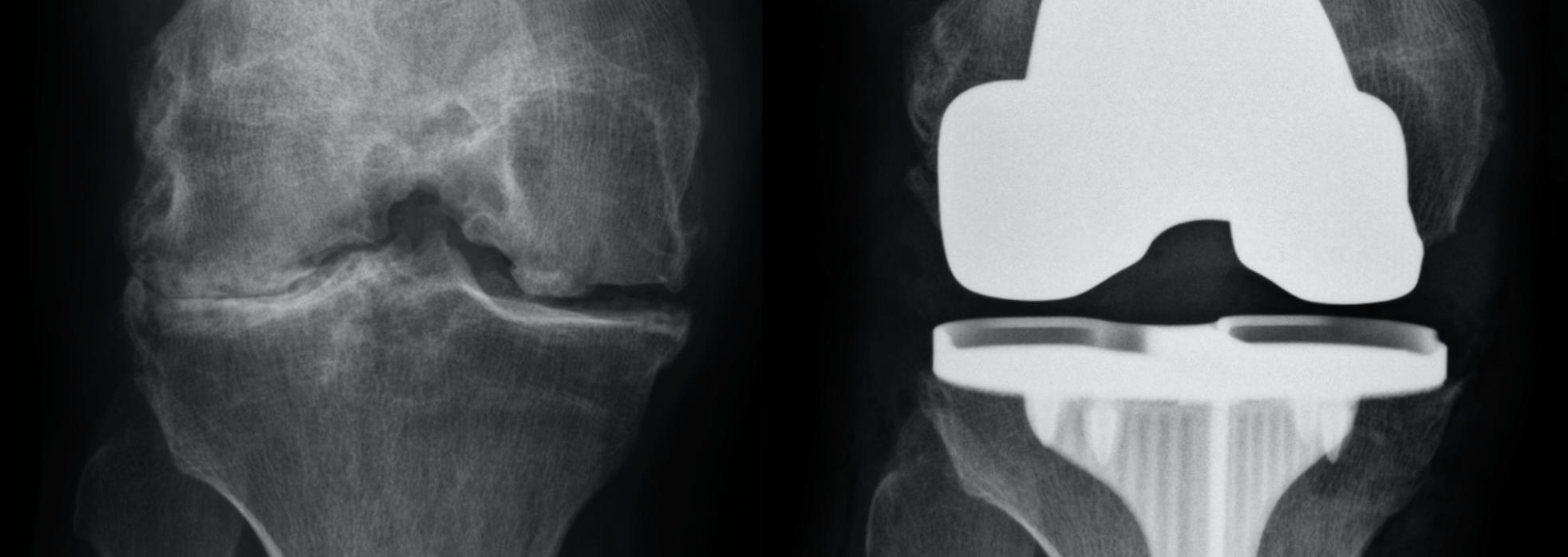 x-rays of a knee joint before and after robotic total knee replacement surgery