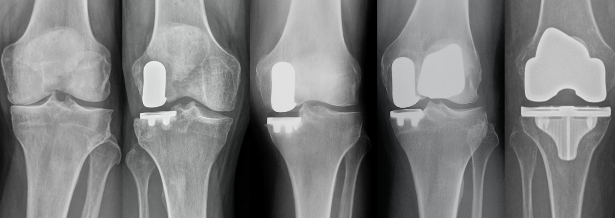 X-rays of knee joint before and after robotic knee replacement surgery