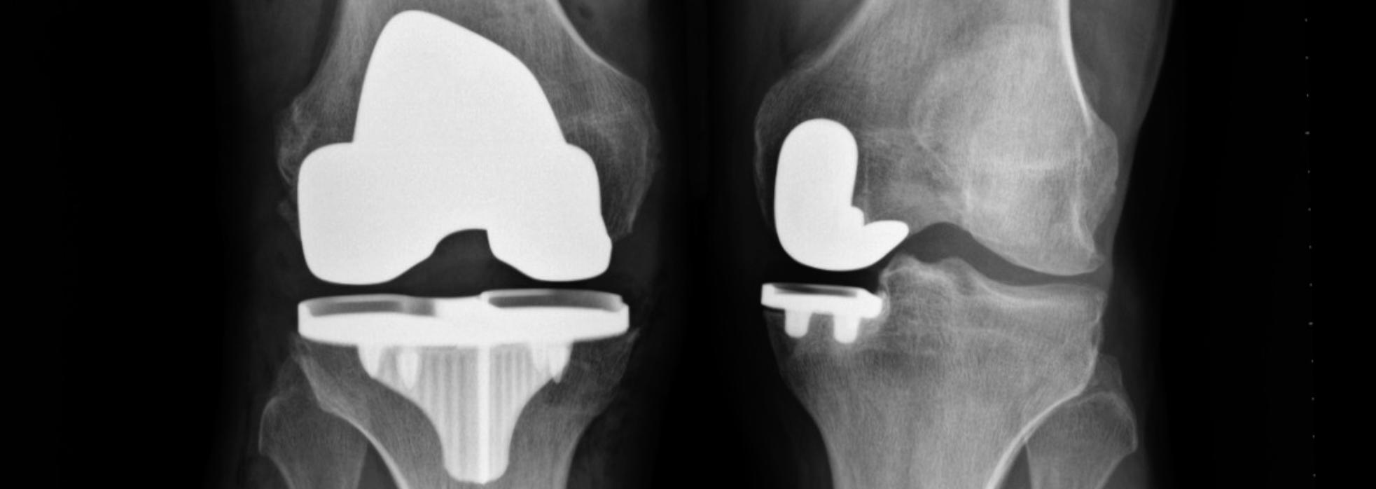 X-ray of a knees after robotic knee replacement surgery