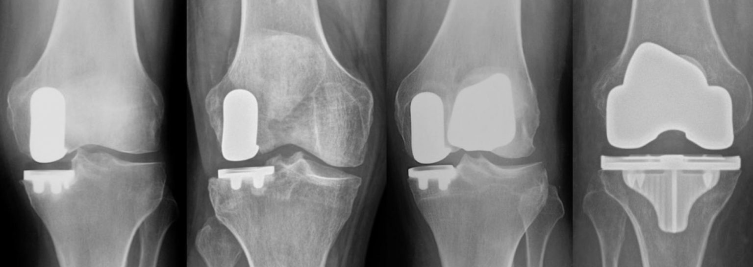 NYC Mako Robotic Total Knee Replacement Dr. Frederick Buechel, Jr.