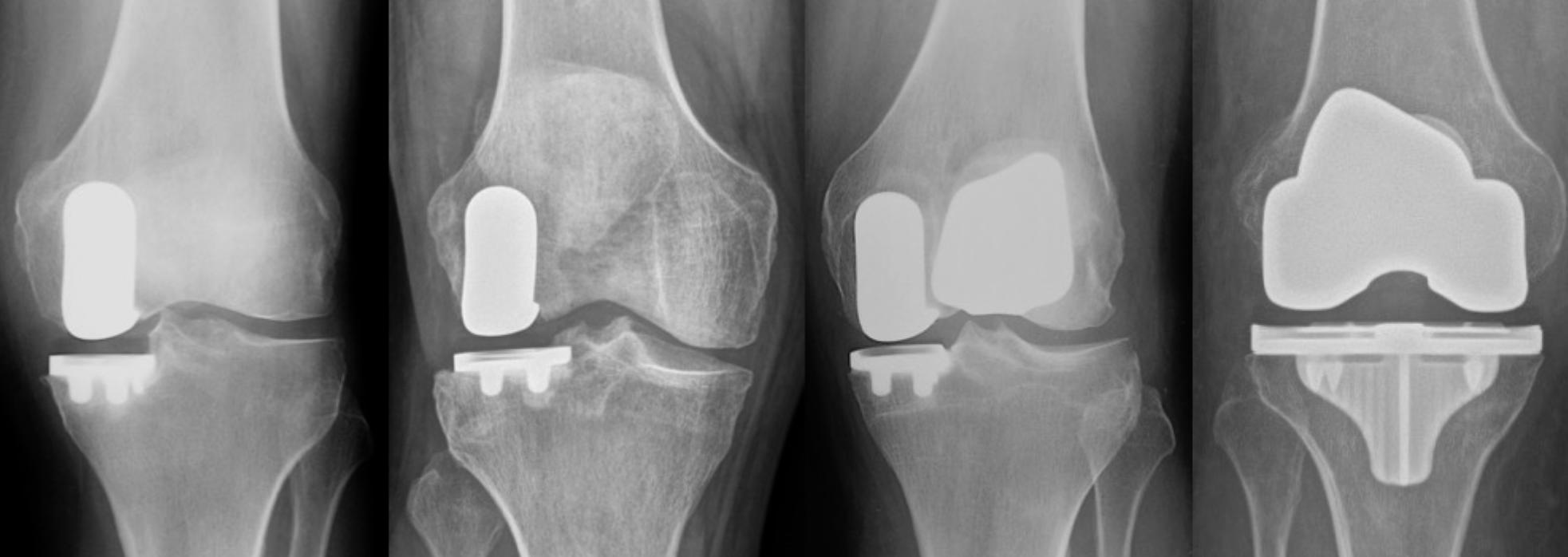 X-rays of a knee joint after robotic knee replacement surgery