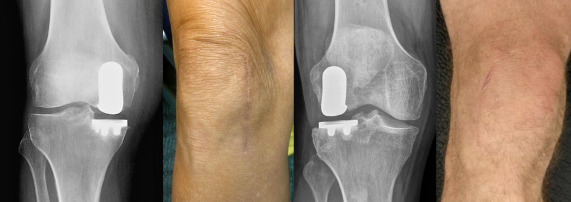 Patients' knees after Mako Robotic knee replacement surgery