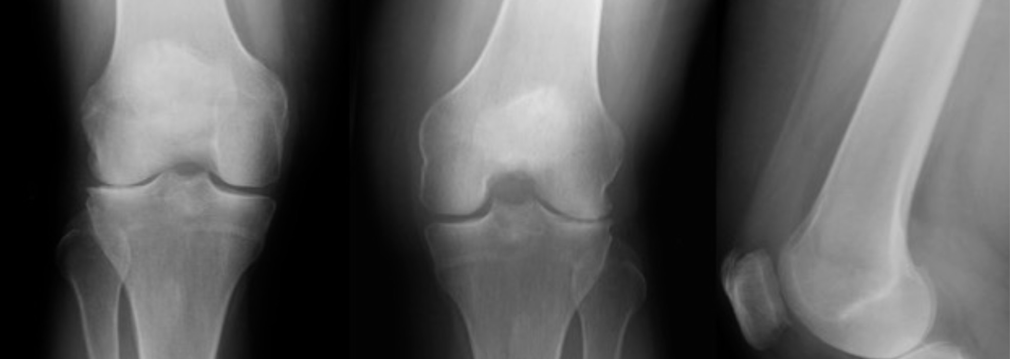 x-rays of knee osteoarthritis