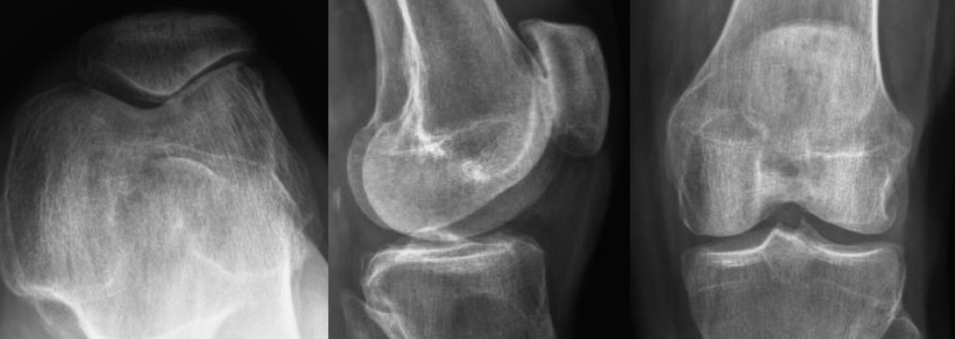 X-rays showing different types of meniscus tears