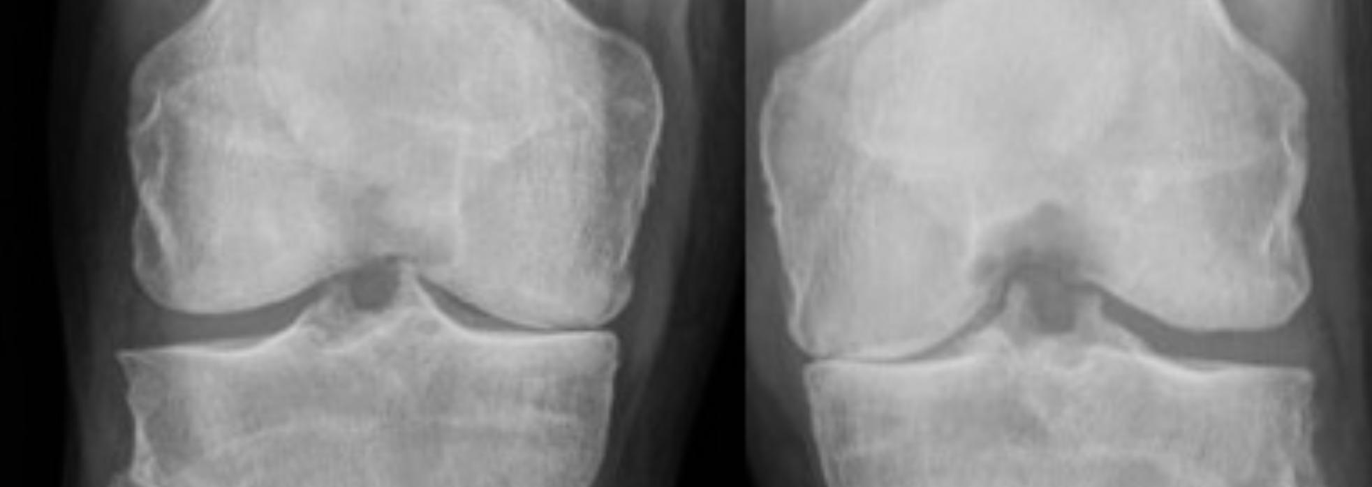 knee x-rays