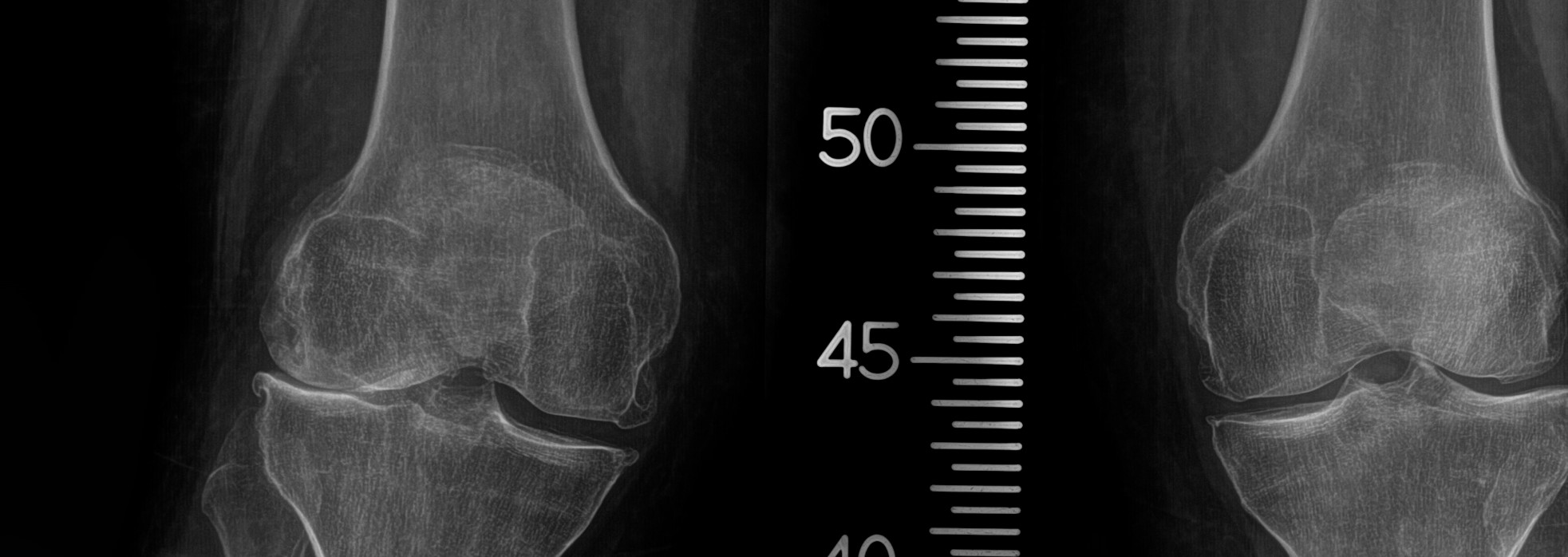 x-rays of knee osteonecrosis