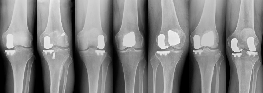 X-ray image showing Partial Knee Replacement Options performed by Dr. Buechel.