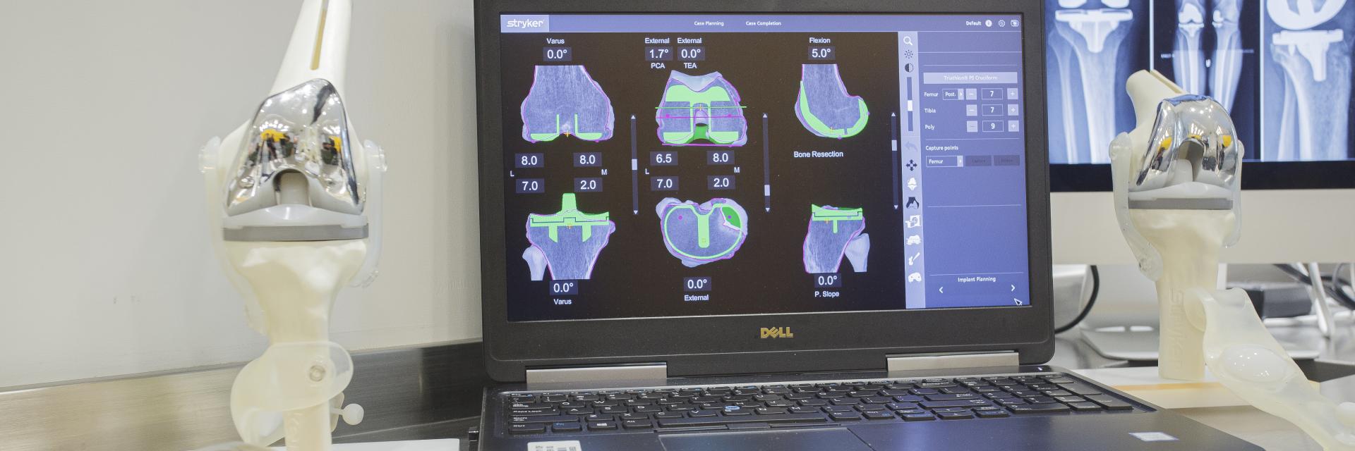 Dr. Buechel Robotic Joint Center, total knee software and model