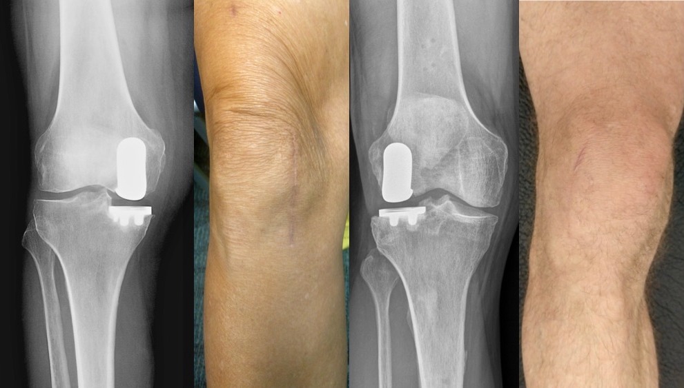 Medial and lateral partial knee replacements with corresponding X-rays and healed incisions