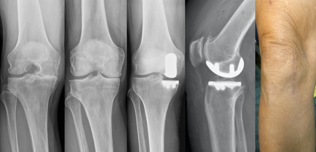 Medial compartment Knee arthritis with a medial partial knee and the healed incision